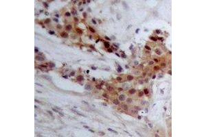 Immunohistochemical analysis of BAP1 staining in human breast cancer formalin fixed paraffin embedded tissue section. (BAP1 抗体)