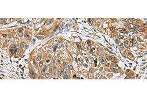Immunohistochemistry of paraffin-embedded Human esophagus cancer tissue using EARS2 Polyclonal Antibody at dilution of 1:30(x200) (EARS2 抗体)