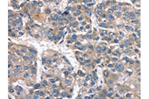 The image on the left is immunohistochemistry of paraffin-embedded Human liver cancer tissue using ABIN7190040(CACNA1G Antibody) at dilution 1/20, on the right is treated with synthetic peptide. (CACNA1G 抗体)