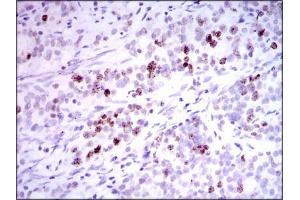 Immunohistochemical analysis of paraffin-embedded cervical cancer tissues using INCENP mouse mAb with DAB staining. (INCENP 抗体  (AA 369-583))