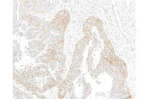 Immunohistochemistry (IHC) image for anti-Met Proto-Oncogene (MET) (C-Term) antibody (ABIN7795683) (Recombinant c-MET 抗体  (C-Term))