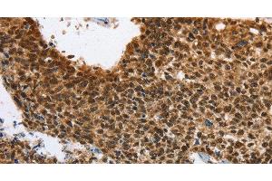 Immunohistochemistry of paraffin-embedded Human lung cancer using ELAVL1 Polyclonal Antibody at dilution of 1:40 (ELAVL1 抗体)
