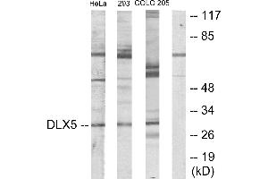 Immunohistochemistry analysis of paraffin-embedded human lung carcinoma tissue using DLX5 antibody.