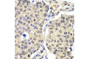 Immunohistochemistry of paraffin-embedded human lung cancer using CCNC antibody at dilution of 1:100 (x40 lens). (Cyclin C 抗体)