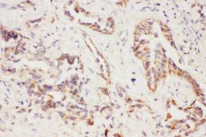 Anti-Eotaxin 3 Picoband antibody,  IHC(P): Human Lung Cancer Tissue (CCL26 抗体  (AA 24-94))