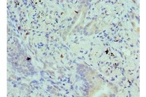 Immunohistochemistry of paraffin-embedded human lung cancer using ABIN7145292 at dilution of 1:100 (BIK 抗体  (AA 1-130))