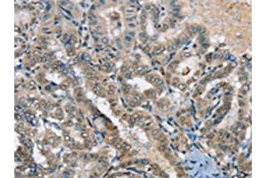 The image on the left is immunohistochemistry of paraffin-embedded Human thyroid cancer tissue using ABIN7192312(SEPN1 Antibody) at dilution 1/20, on the right is treated with synthetic peptide. (Selenoprotein N 抗体)