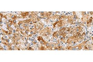 Immunohistochemistry of paraffin-embedded Human liver cancer tissue using NMU Polyclonal Antibody at dilution of 1:80(x200) (Neuromedin U 抗体)