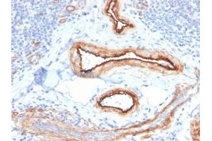 Formalin-fixed, paraffin-embedded human Renal Cell Carcinoma stained with MTF1 Mouse Monoclonal Antibody (MTF1/2649). (MTF1 抗体)