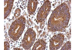IHC-P Image Immunohistochemical analysis of paraffin-embedded human colon carcinoma, using Laminin beta 1, antibody at 1:500 dilution. (Laminin beta 1 抗体  (C-Term))