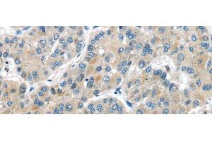 Immunohistochemistry of paraffin-embedded Human liver cancer tissue using MASP2 Polyclonal Antibody at dilution 1:35 (MASP2 抗体)