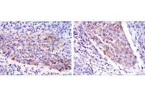 Immunohistochemical analysis of paraffin-embedded human cervical cancer tissues (left) and human kidney cancer tissues (right) using MMP1 mouse mAb with DAB staining. (MMP1 抗体)