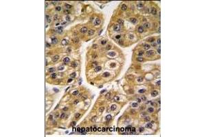 Immunohistochemistry (Paraffin-embedded Sections) (IHC (p)) image for anti-Isocitrate Dehydrogenase 1 (NADP+), Soluble (IDH1) (AA 116-143) antibody (ABIN391660)