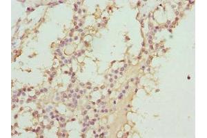 Immunohistochemistry of paraffin-embedded human breast cancer using ABIN7144903 at dilution of 1:100 (ABCC11 抗体  (AA 1-170))