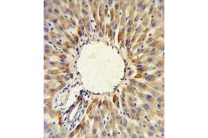 HMGCS2 Antibody (C-term) (ABIN390764 and ABIN2841022) IHC analysis in formalin fixed and paraffin embedded human hepatocarcinoma followed by peroxidase conjugation of the secondary antibody and DAB staining. (HMGCS2 抗体  (C-Term))