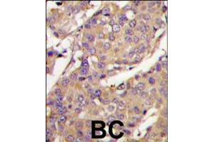 Formalin-fixed and paraffin-embedded breast carcinoma tissue reacted with UBE2L6 Antibody , which was peroxidase-conjugated to the secondary antibody, followed by DAB staining. (UBE2L6 抗体  (C-Term))