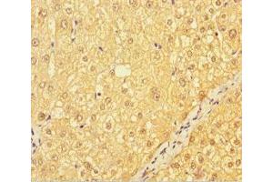 Immunohistochemistry of paraffin-embedded human liver cancer using ABIN7147035 at dilution of 1:100 (CATSPER4 抗体  (AA 306-472))