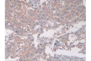IHC-P analysis of Human Breast Cancer Tissue, with DAB staining. (Coxsackie Adenovirus Receptor 抗体  (AA 20-229))