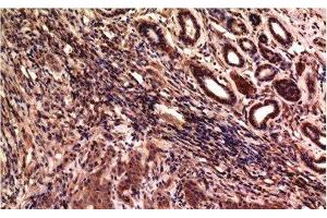 Immunohistochemistry of paraffin-embedded Human breast carcinoma tissue using gamma Tubulin Monoclonal Antibody at dilution of 1:200. (TUBG1 抗体)