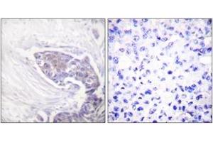 Immunohistochemistry analysis of paraffin-embedded human breast carcinoma tissue, using TRXR2 Antibody. (TXNRD2 抗体  (AA 471-520))