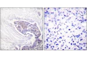 Immunohistochemistry analysis of paraffin-embedded human breast carcinoma tissue, using TRXR2 Antibody. (TXNRD2 抗体  (AA 471-520))