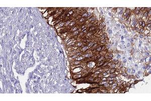 ABIN6268717 at 1/100 staining Human urothelial cancer tissue by IHC-P. (Aquaporin 5 抗体  (C-Term))