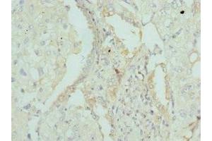 Immunohistochemistry of paraffin-embedded human lung cancer using ABIN7144441 at dilution of 1:100 (Apolipoprotein M 抗体  (AA 23-188))