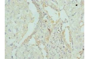 Immunohistochemistry of paraffin-embedded human lung cancer using ABIN7144441 at dilution of 1:100