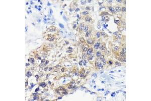 Immunohistochemistry of paraffin-embedded human lung cancer using  antibody (ABIN7265709) at dilution of 1:100 (40x lens). (ATG3 抗体)