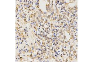 Immunohistochemistry of paraffin-embedded human lung cancer using ATG5 antibody (ABIN4902970) at dilution of 1:100 (40x lens). (ATG5 抗体)