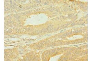 Immunohistochemistry of paraffin-embedded human endometrial cancer using ABIN7156048 at dilution of 1:100 (SLC1A2 抗体  (AA 306-348))