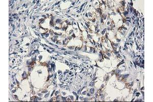 Immunohistochemical staining of paraffin-embedded Carcinoma of Human lung tissue using anti-C1orf50 mouse monoclonal antibody. (C1ORF50 抗体)