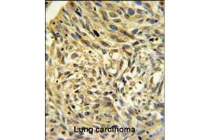 FKBP14 Antibody IHC analysis in formalin fixed and paraffin embedded human Lung carcinoma followed by peroxidase conjugation of the secondary antibody and DAB staining. (FKBP14 抗体  (N-Term))