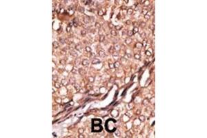 Formalin-fixed and paraffin-embedded human cancer tissue reacted with the primary antibody, which was peroxidase-conjugated to the secondary antibody, followed by AEC staining. (BAIAP2 抗体  (C-Term))