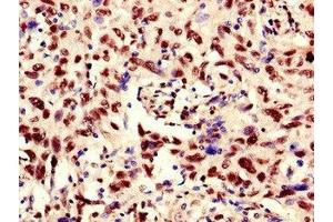 Immunohistochemistry of paraffin-embedded human lung cancer using ABIN7168329 at dilution of 1:100 (RNA Binding Motif Protein, Y Chromosome (RBMY) (AA 501-700) 抗体)