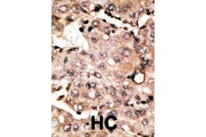 Formalin-fixed and paraffin-embedded human cancer tissue reacted with the primary antibody, which was peroxidase-conjugated to the secondary antibody, followed by DAB staining. (ATG4D 抗体  (C-Term))