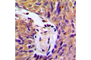 Immunohistochemical analysis of IKK alpha/beta (pS180/181) staining in human breast cancer formalin fixed paraffin embedded tissue section. (IKK-alpha /IKK-beta 抗体  (pSer180, pSer181))