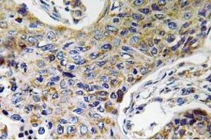 Immunohistochemistry (IHC) analyzes of ATP5J2 antibody in paraffin-embedded human lung carcinoma tissue. (ATP5J2 抗体  (Subunit F))