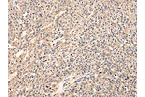 The image on the left is immunohistochemistry of paraffin-embedded Human breast cancer tissue using ABIN7128083(VIP Antibody) at dilution 1/20, on the right is treated with fusion protein. (Vip 抗体)