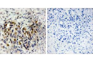 Peptide - +Immunohistochemistry analysis of paraffin-embedded human breast carcinoma tissue, using IRX3 antibody. (IRX3 抗体)