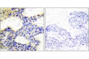 Immunohistochemistry analysis of paraffin-embedded human breast carcinoma tissue, using S6K Antibody. (RPS6KB1 抗体  (AA 261-310))