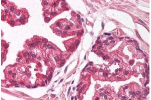 Human Prostate (formalin-fixed, paraffin-embedded) stained with NFIA antibody ABIN214127 at 5 ug/ml followed by biotinylated goat anti-rabbit IgG secondary antibody ABIN481713, alkaline phosphatase-streptavidin and chromogen. (NFIA 抗体  (AA 348-397))