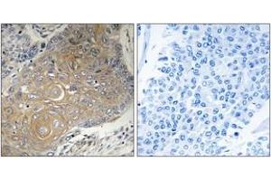 Immunohistochemistry analysis of paraffin-embedded human lung carcinoma tissue, using MRPS33 Antibody. (MRPS33 抗体  (AA 51-100))