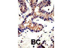 Formalin-fixed and paraffin-embedded human cancer tissue reacted with UBQLN3 polyclonal antibody  , which was peroxidase-conjugated to the secondary antibody, followed by DAB staining . (Ubiquilin 3 抗体  (N-Term))