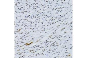 Immunohistochemistry of paraffin-embedded human uterine cancer using SNRNP70 antibody. (SNRNP70 抗体  (AA 150-250))