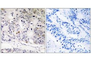 Immunohistochemistry analysis of paraffin-embedded human colon carcinoma tissue using UBTD1 antibody. (UBTD1 抗体  (Internal Region))