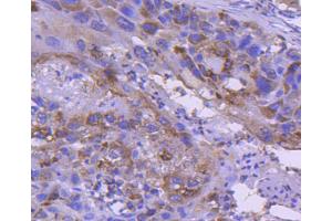 Paraformaldehyde-fixed, paraffin embedded human lung carcinoma, Antigen retrieval by boiling in sodium citrate buffer (pH6) for 15min, Block endogenous peroxidase by 3% hydrogen peroxide for 30 minutes, Blocking buffer (normal serum) at 37°C for 20min, Antibody incubation with IRF5 (3F11) Monoclonal Antibody  at 1:50 overnight at 4°C, followed by a conjugated secondary and DAB staining. (IRF5 抗体)