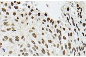 Immunohistochemistry of paraffin-embedded Human lung cancer using SFPQ Polyclonal Antibody at dilution of 1:100 (40x lens).