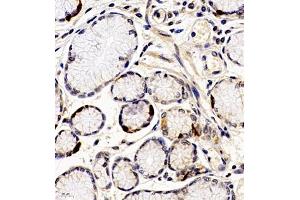 Immunohistochemistry of paraffin embedded human gastric cancer using ANKK1 (ABIN7073056) at dilution of 1:200 (400x lens)