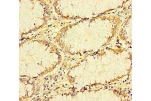 Immunohistochemistry of paraffin-embedded human colon cancer using ABIN7173655 at dilution of 1:100 (TUBA1B 抗体  (AA 29-310))